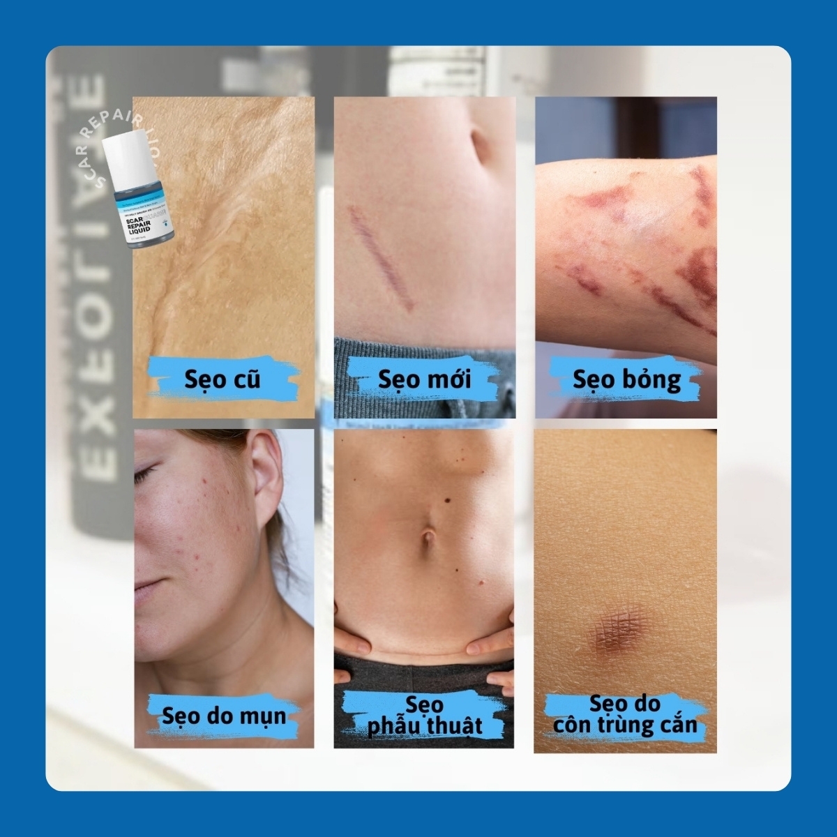 Gel Trị Sẹo Lồi Scarguard Repair Liquid 15ml (Scarguard MD)