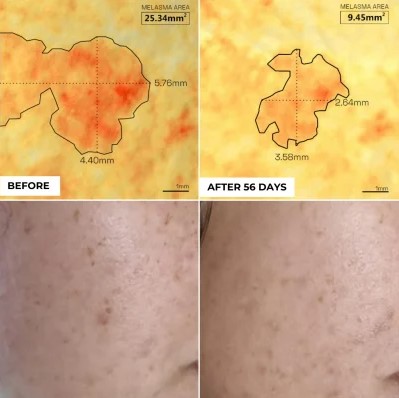 Tinh chất trị nám, giảm tàn nhang DermEden Concentrate Anti-Taches Dark Spots